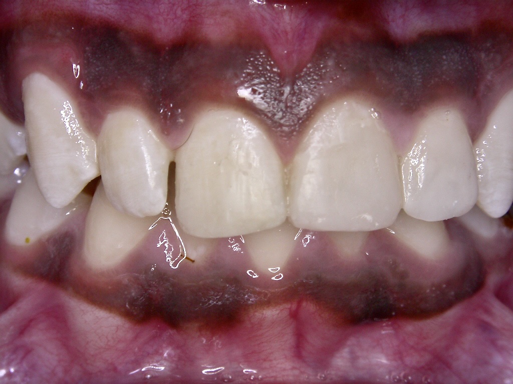 Completed restorations